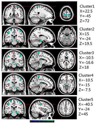 Regional brain atrophy in patients with chronic ankle instability: A voxel-based morphometry study